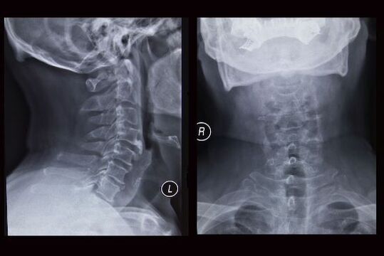 ภาพเอ็กซ์เรย์ของกระดูกสันหลังส่วนคอ (ผู้ป่วยมีภาวะกระดูกพรุน)