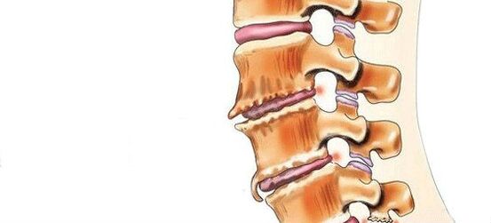 spondylosis - การทำลายข้อต่อ intervertebral