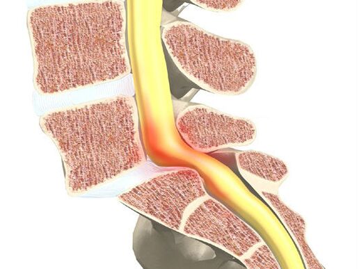 ส่วนของเลือดในเลือดสำหรับ osteochondrosis